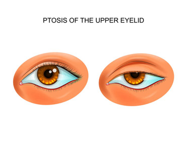 ptosis repair graphic