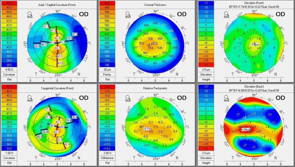 Post Prk Clinical Perspective on Keratoconus Treatment: A Case Study